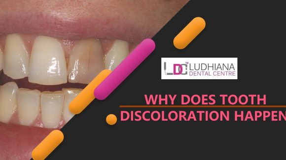 Why does Tooth Discoloration Happen?