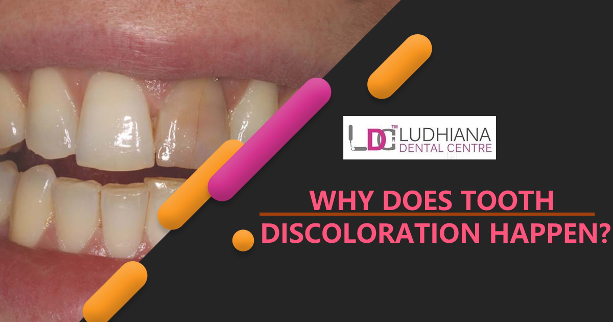 Some Common Causes of Teeth Discoloration