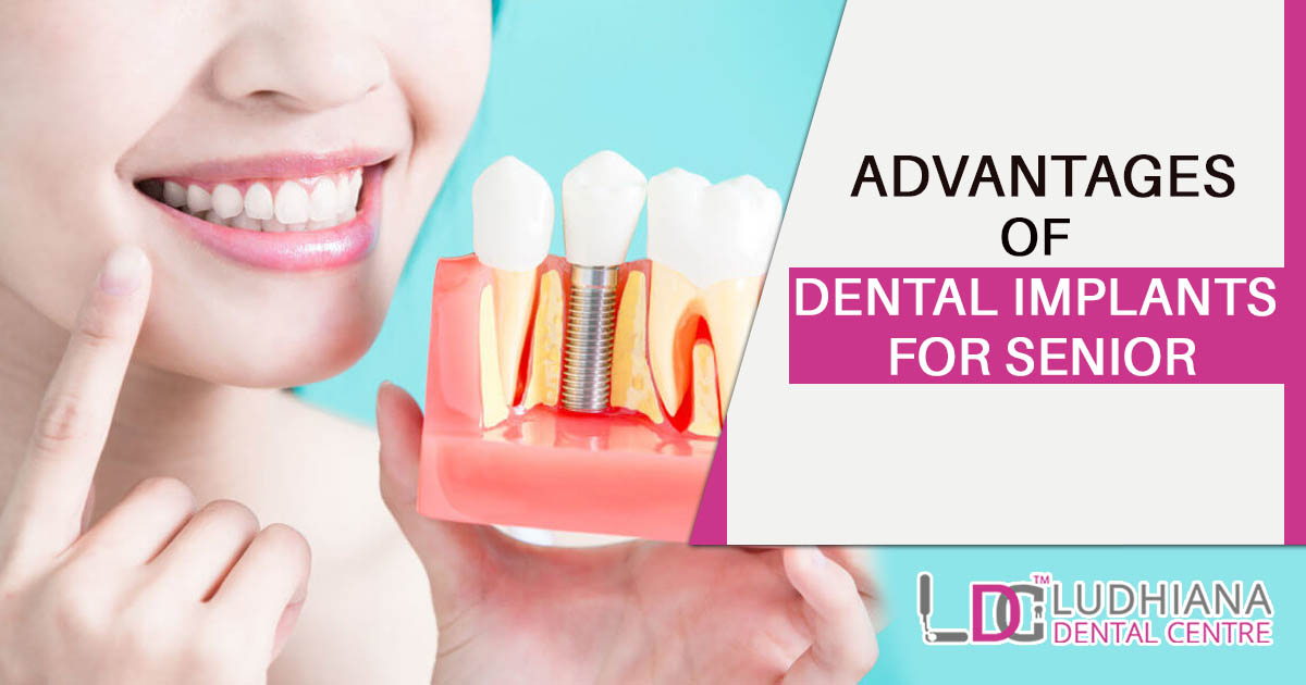 Advantages of Dental Implants for Senior