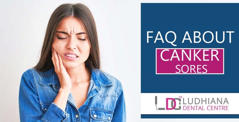 FAQ About Canker Sores