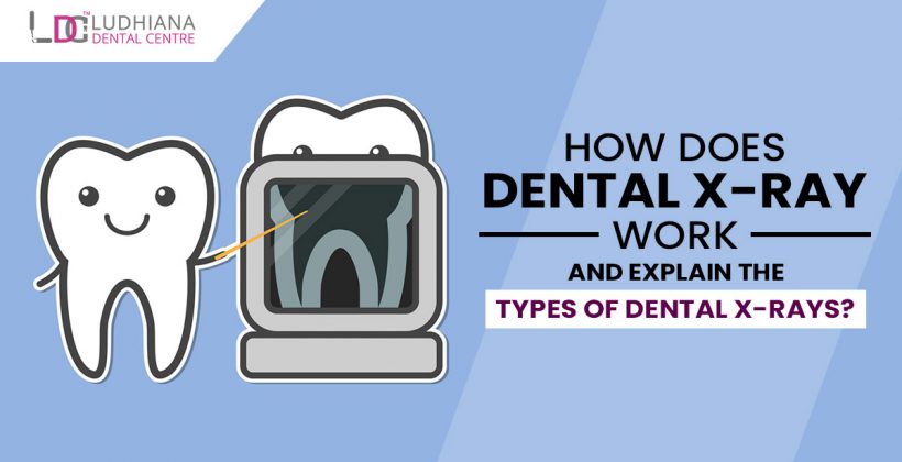 How does dental x-ray work and explain the types of dental x-rays?