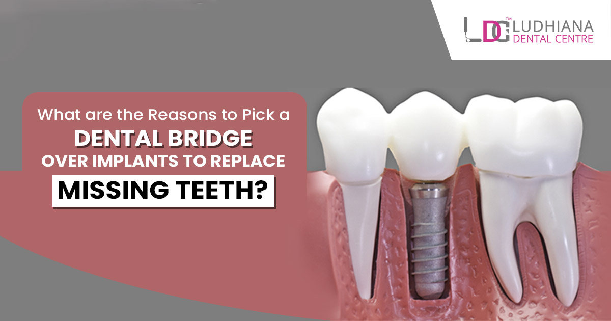 What are the reasons to pick a dental bridge over implants to replace missing teeth?