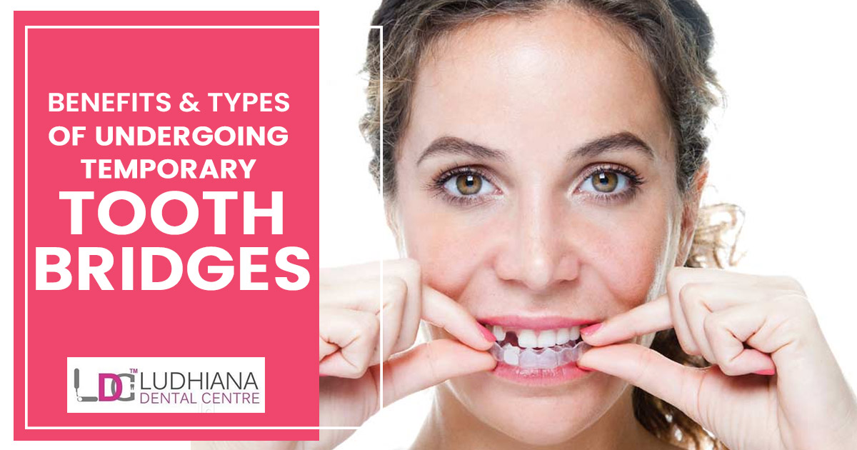 What are the benefits and types of undergoing temporary tooth bridges?