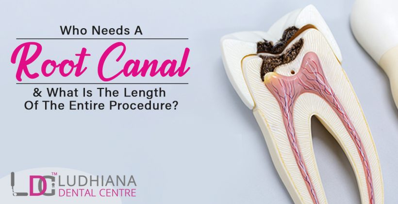 Who needs a root canal and what is the length of the entire procedure?