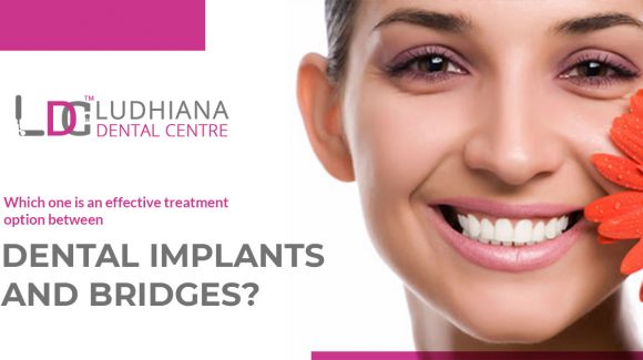 Which one is an effective treatment option between dental implants and bridges?