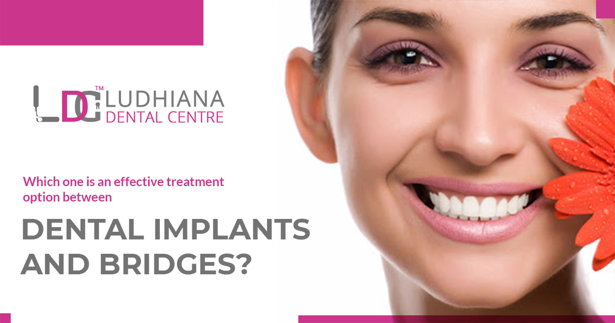 Which one is an effective treatment option between dental implants and bridges?