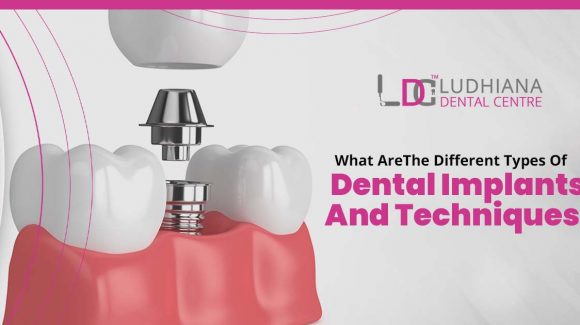 What are the different types of dental implants and techniques?