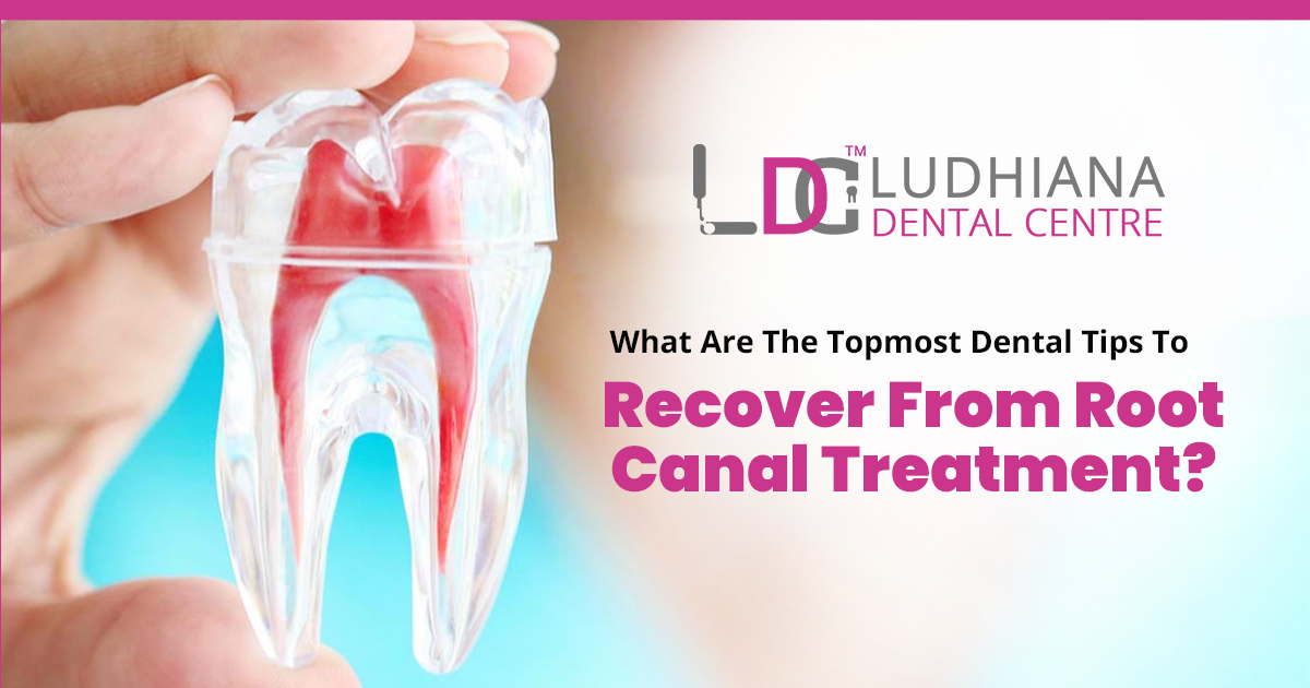 What are the topmost dental tips to recover from root canal treatment?