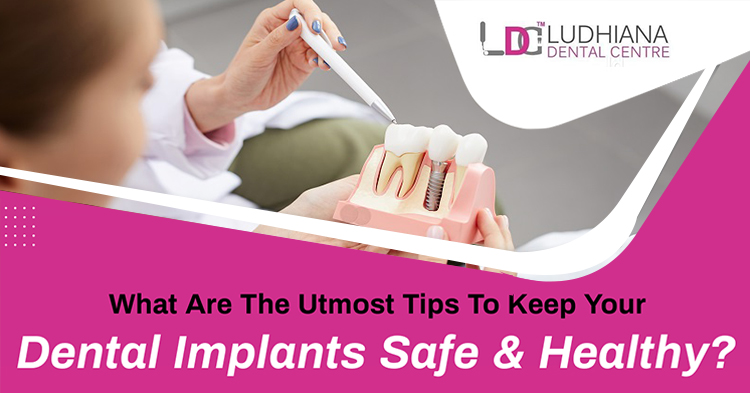 What are the utmost tips to keep your dental implants safe & healthy?