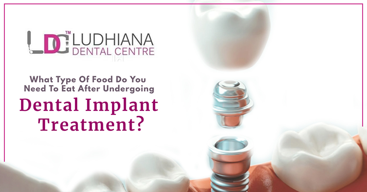What type of food do you need to eat after undergoing dental implant treatment?