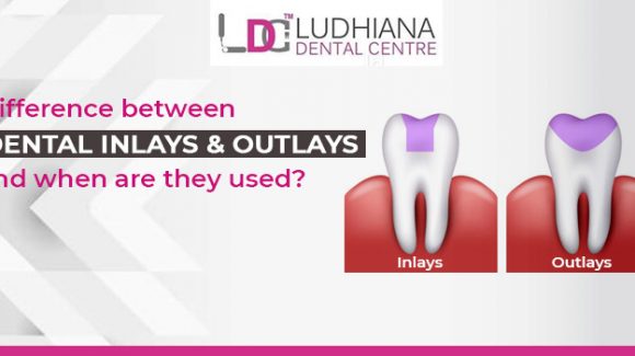 Difference between Dental inlays and outlays and when are they used?