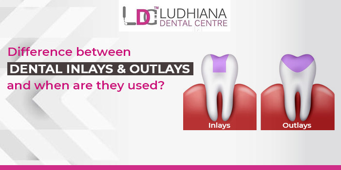 Difference between Dental inlays and outlays and when are they used?