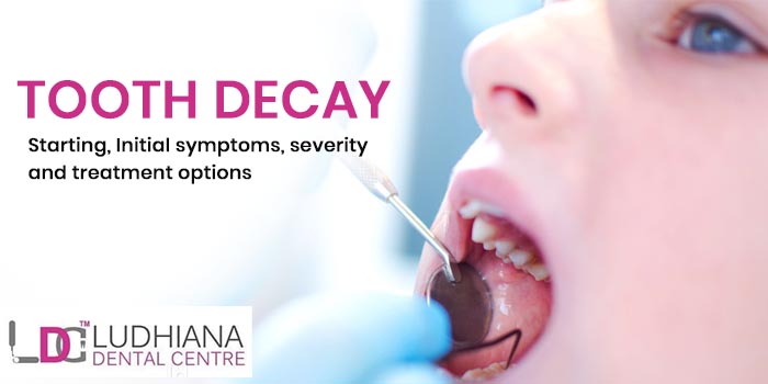 Tooth decay – Starting, Initial symptoms, severity and treatment options.