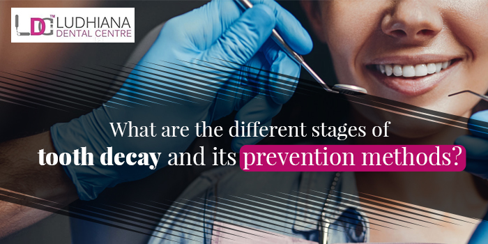 What are the different stages of tooth decay and its prevention methods?