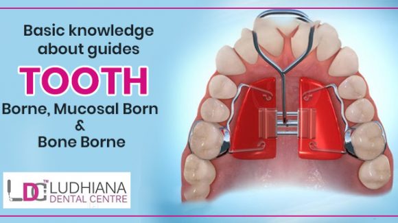 Basic knowledge about guides – Tooth- Borne, Mucosal Born and Bone Borne