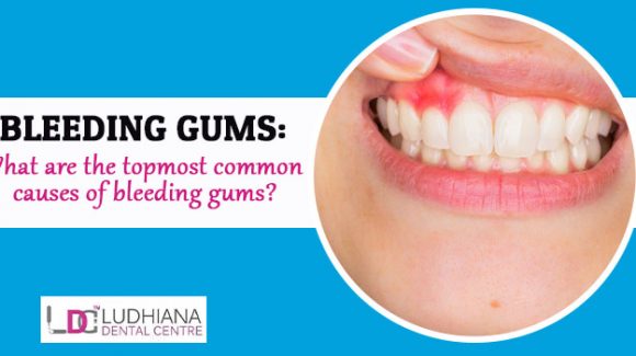 Bleeding Gums: What are the topmost common causes of bleeding gums?