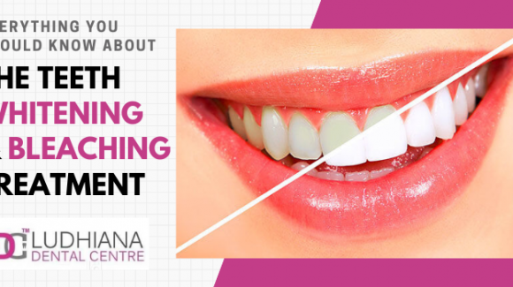 Everything you should know about the teeth whitening and bleaching treatment