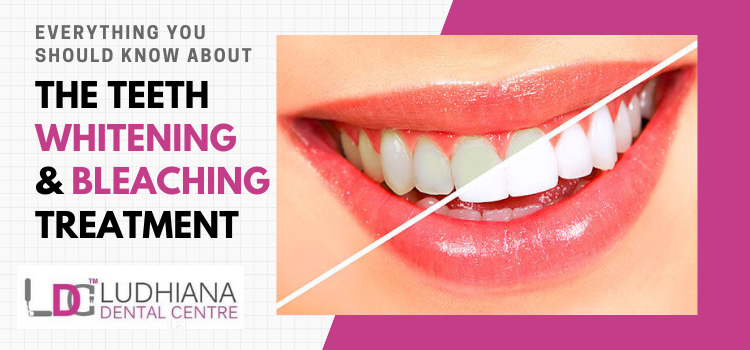 Everything you should know about the teeth whitening and bleaching treatment
