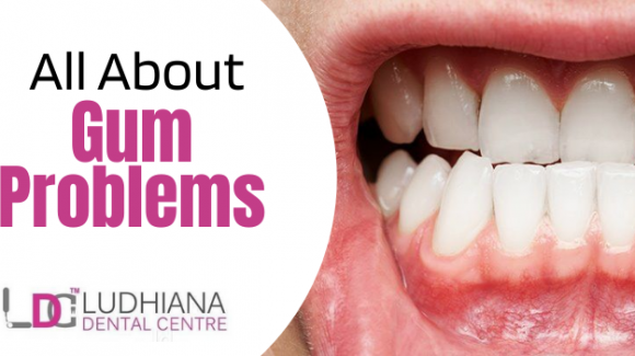 Ludhiana Dental Centre’s Special Guide – What are the Gum Problems?