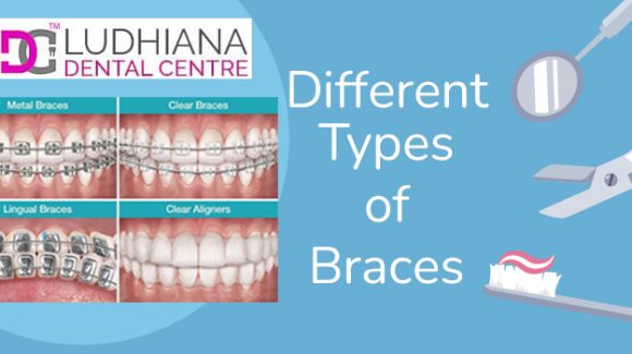 Dental treatment: Which are the most common types of braces?