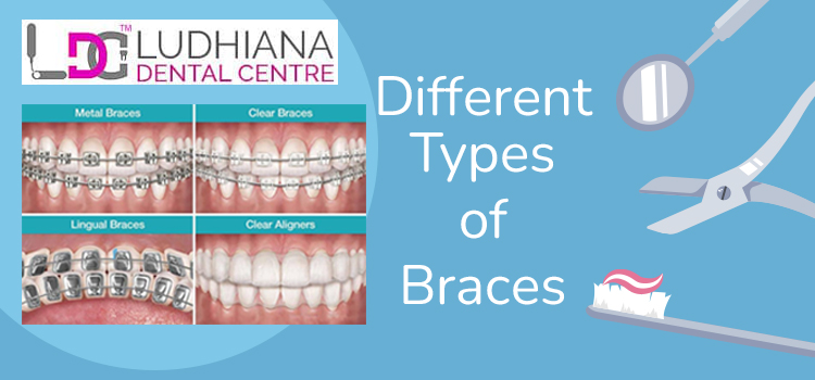 Dental treatment: Which are the most common types of braces?