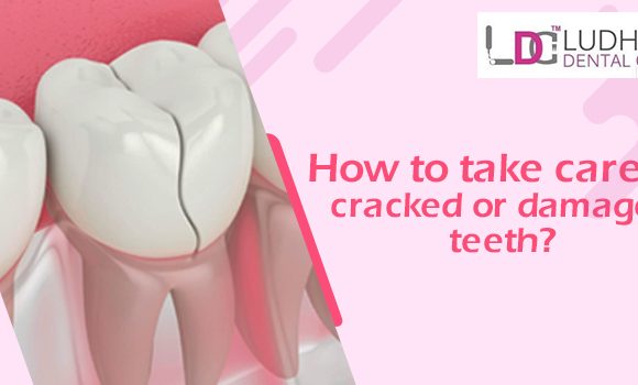 Dentist tips to take care of damaged, cracked, or painful teeth