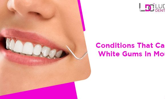 4 Health Conditions That Could Lead To White Or Pale Gums In Mouth