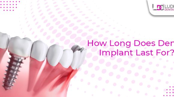 Dental Implant: How long do dental implants last for tooth replacement?