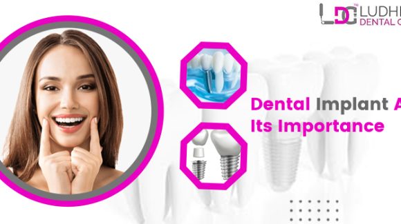 What Are Dental Implants, And Who Is It Necessary To Have One?