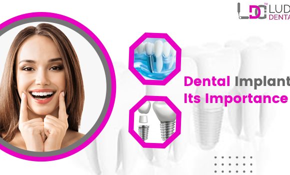 What Are Dental Implants, And Who Is It Necessary To Have One?