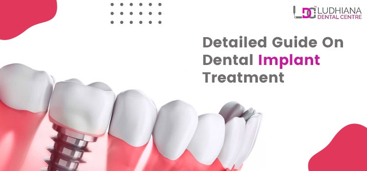 Detailed Guide On Dental Implant Treatment