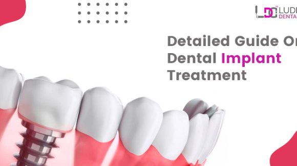 Everything you need to know about the dental implant treatment