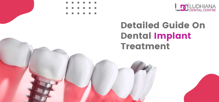 डेंटल इम्प्लांट या दंत प्रत्यारोपण सर्जरी – की क्या है सावधानियां, प्रक्रिया और जोखिम ?