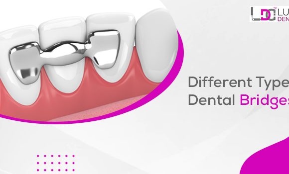 Four Types Of Dental Bridge Implants And Its Costs In Ludhiana