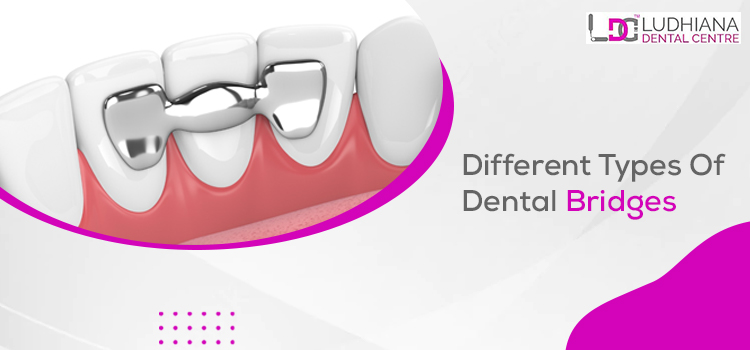 Four Types Of Dental Bridge Implants And Its Costs In Ludhiana
