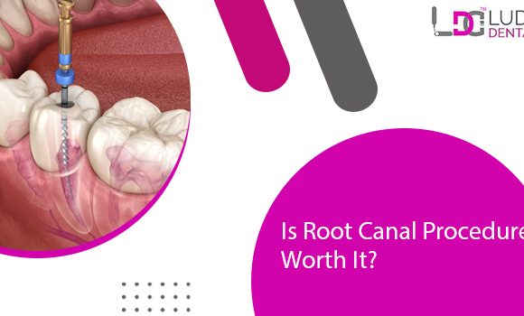 Root canal treatment: Benefit by avoiding unnecessary extractions