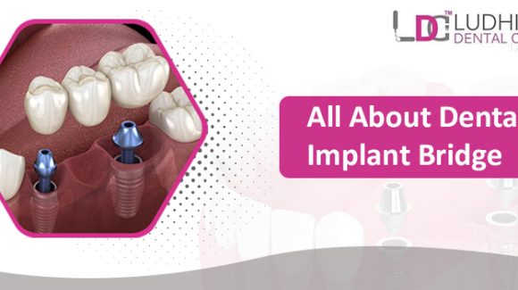 Why Dental Implants in India are a Cost-Effective Solution for Missing Teeth
