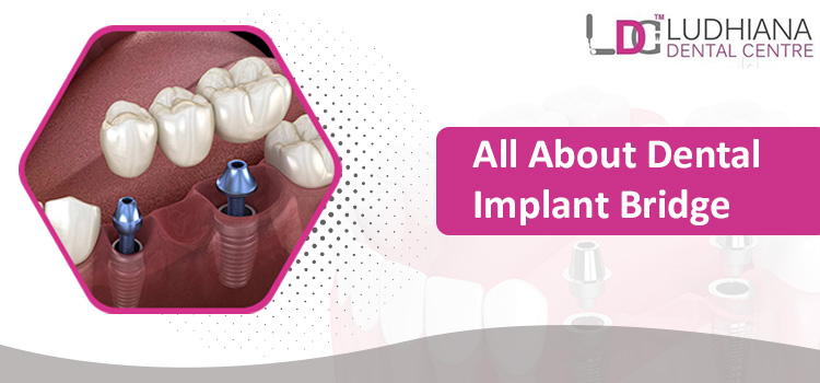 Why Dental Implants in India are a Cost-Effective Solution for Missing Teeth