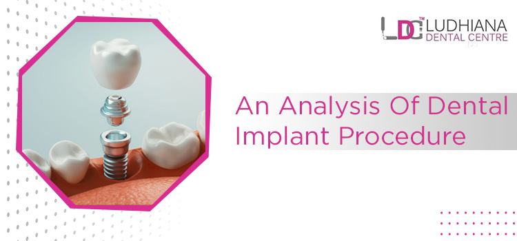What Are The Advantages Of Choosing A Dental Implant Procedure?