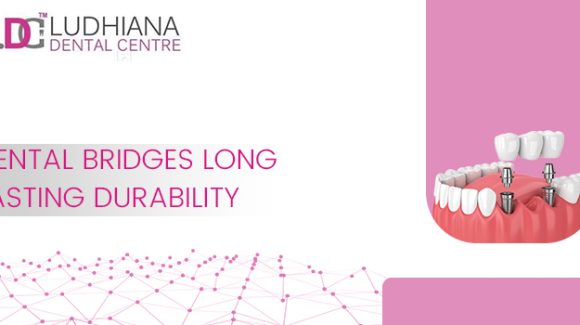 How To Make Sure Your Dental Bridges Are Lasting For A Long Time?