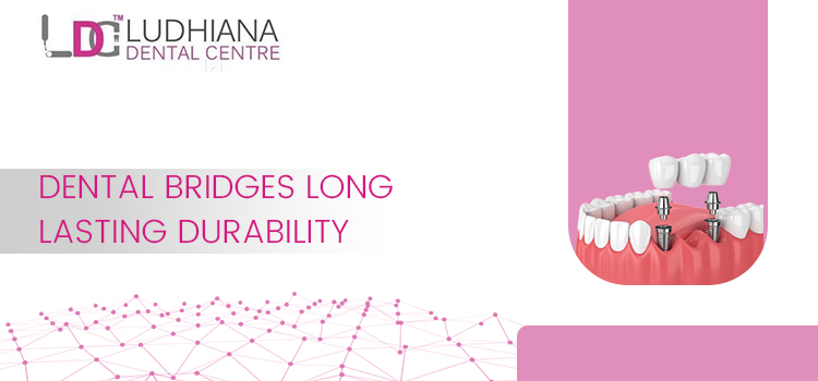 How To Make Sure Your Dental Bridges Are Lasting For A Long Time?