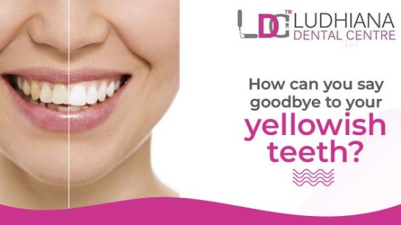Which categories of teeth whitening help to turn your yellowish teeth into white ones?