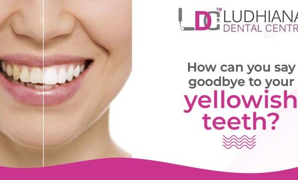 Which categories of teeth whitening help to turn your yellowish teeth into white ones?