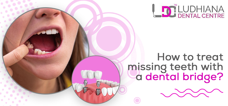 How helpful is a dental bridge treatment for your missing teeth?