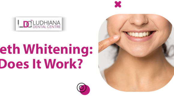 Teeth Whitening Treatment: Is the treatment safe, and does it work?