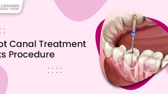 What Is Root Canal Treatment And How Does The Dentist Conduct It?