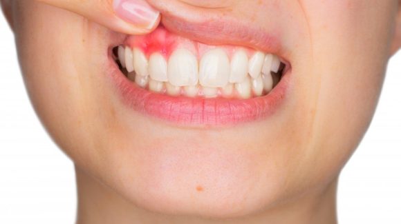 डेंटल इम्प्लांट बिना दांत वालों के लिए कैसे असली दांत की तरह करते है काम ?