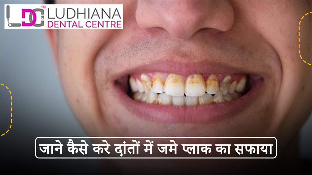 जाने कैसे करे दांतों में जमे प्लाक का सफाया