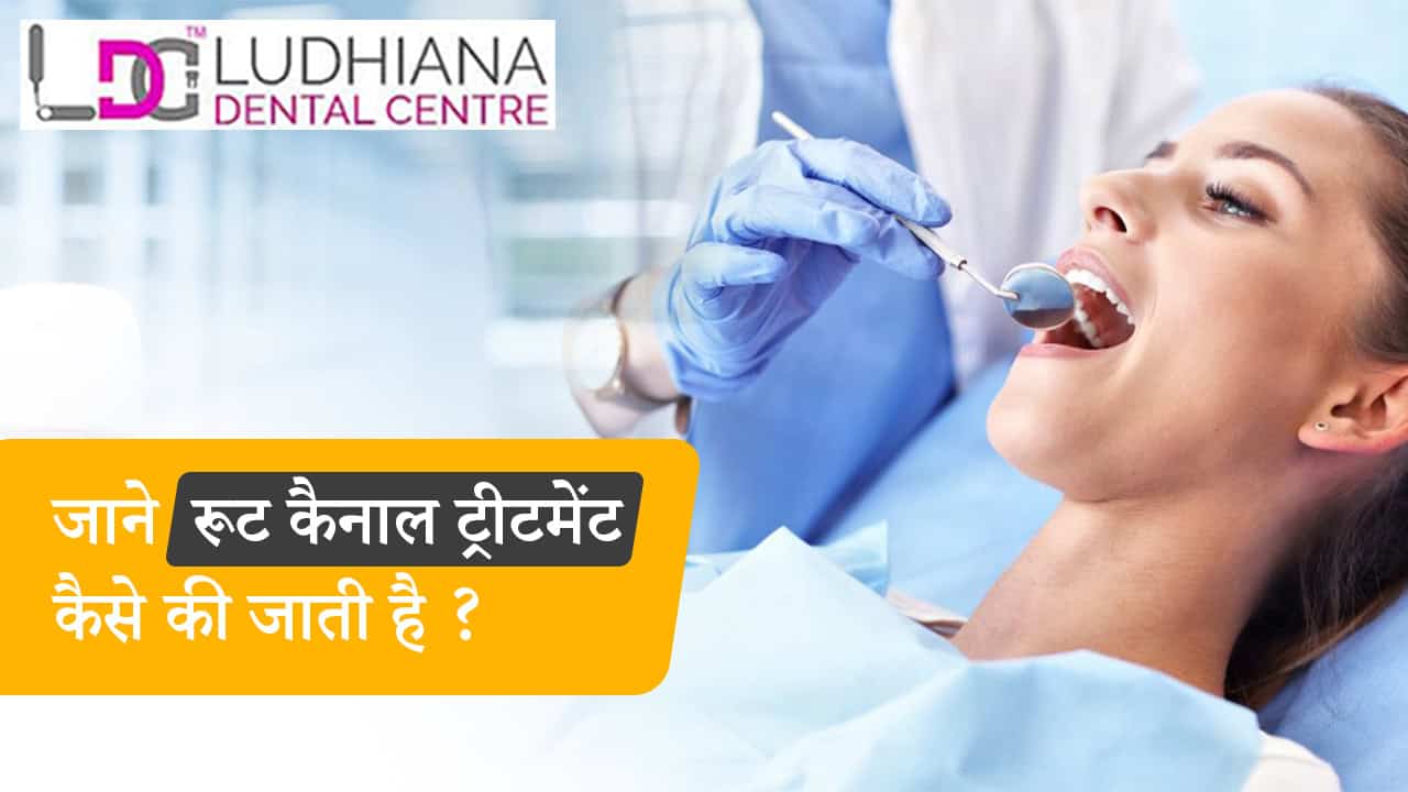 जाने रूट कैनाल ट्रीटमेंट कैसे की जाती है ?