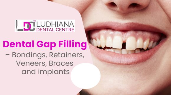 Dental Gap Filling – Bondings, Retainers, Veneers, Braces and implants